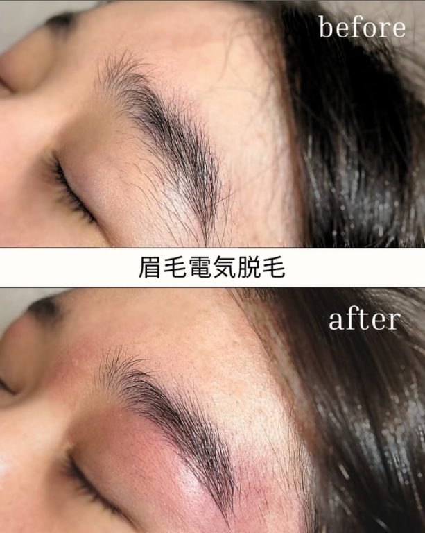 眉毛脱毛大阪