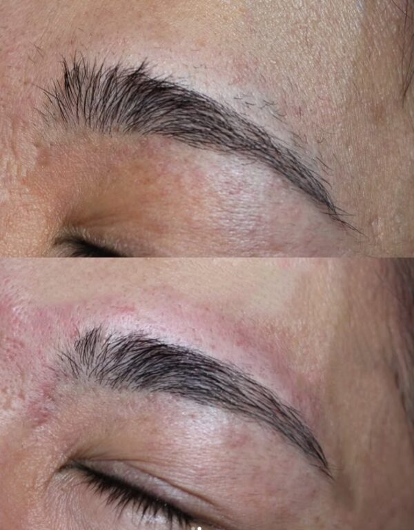 眉毛脱毛大阪