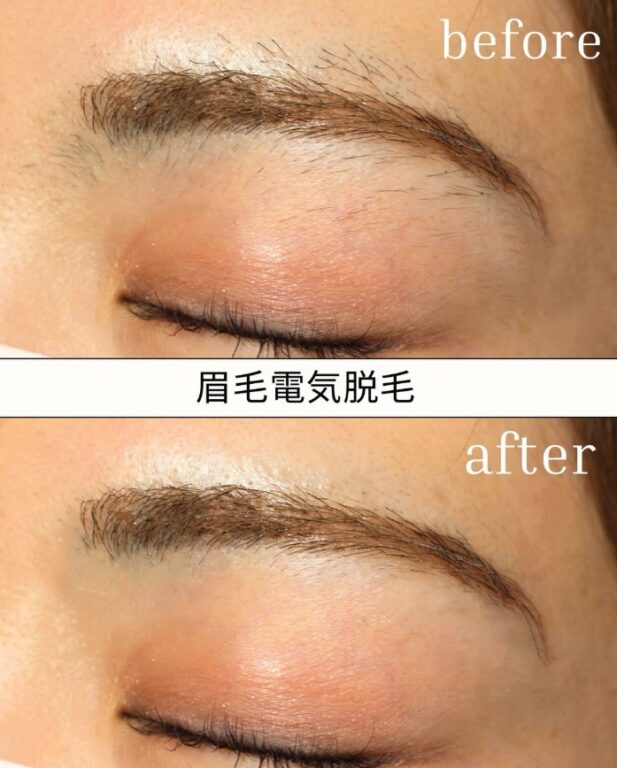 眉毛ニードル脱毛大阪