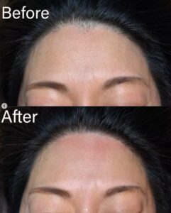 ニードル脱毛 大阪