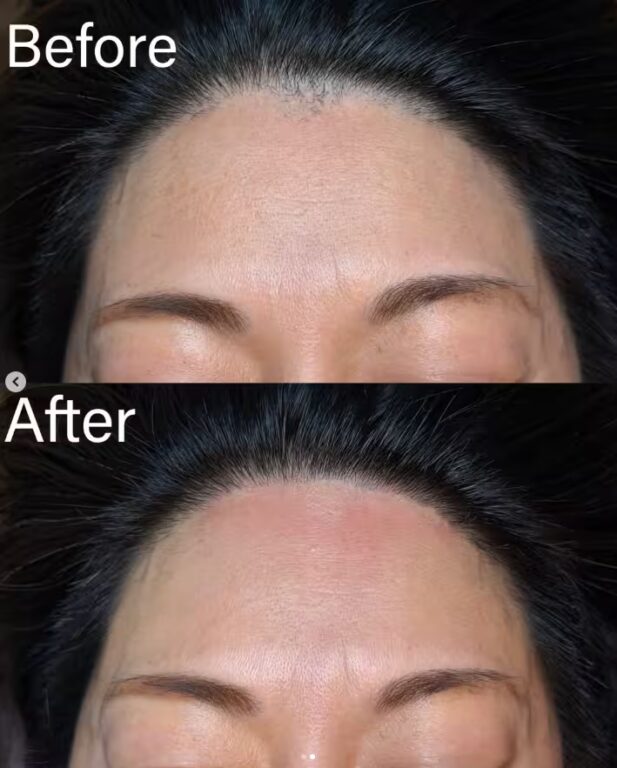 ニードル脱毛 大阪