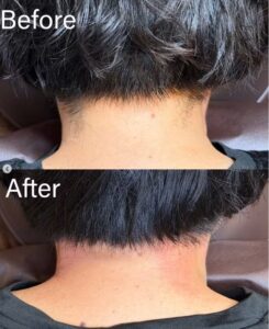 うなじ毛ニードル脱毛