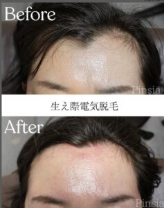 ニードル脱毛ビフォーアフター.jpg