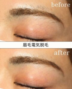 眉毛ニードル脱毛大阪.jpg